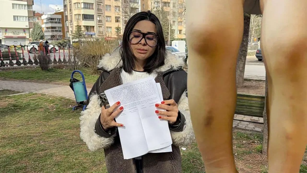 Eskişehir'de kreşte darp iddiasıyla suç duyurusunda bulunan anne ve çocuğunun bacağındaki morluklar.