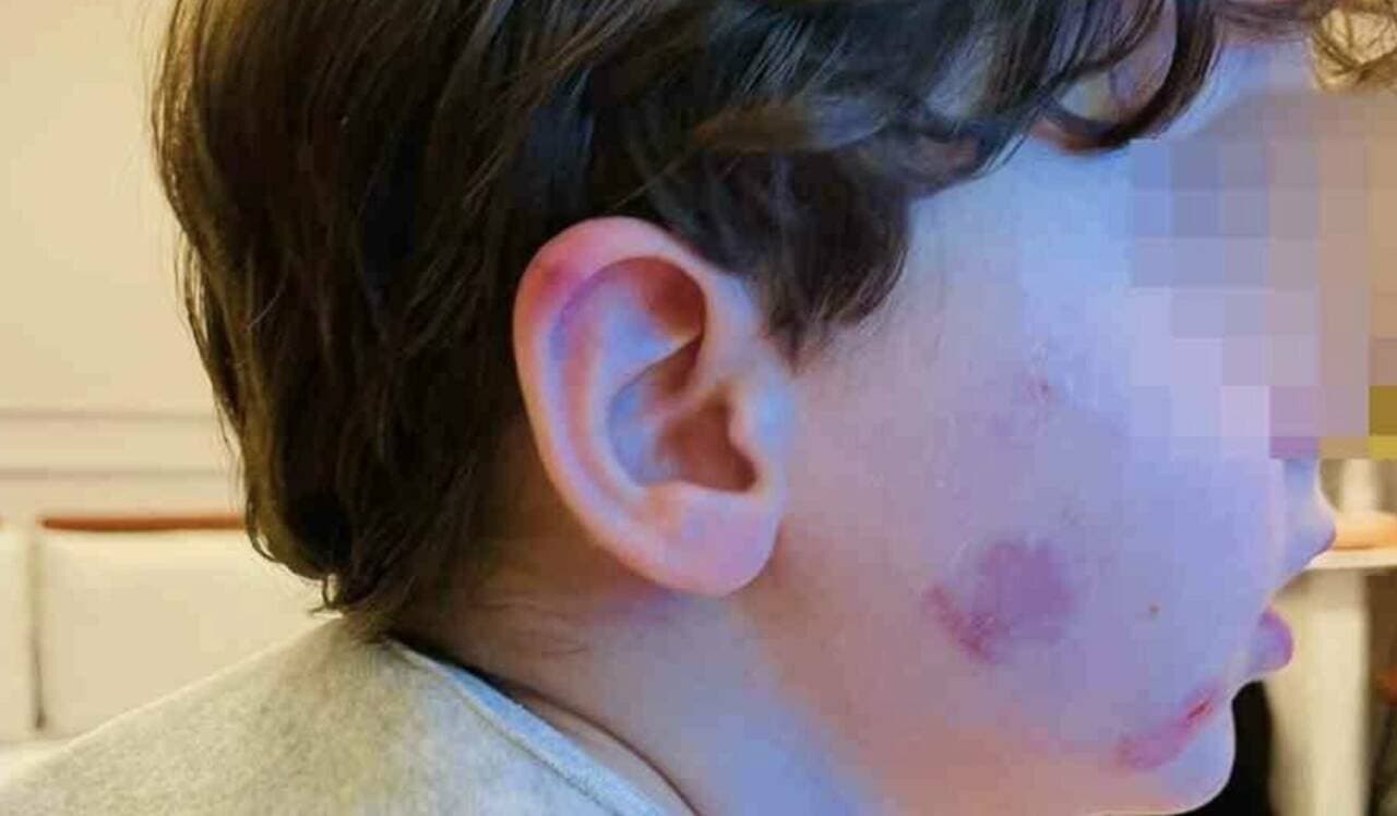 Gemlik'te bir kreşte darp edildiği iddia edilen küçük çocuğun yüzündeki ve kulağındaki yara izleri.
