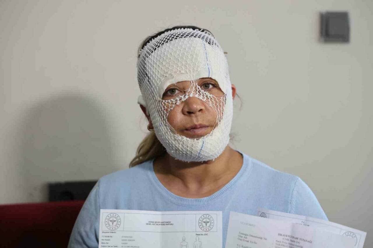 Adana'da Güzellik Merkezi Kabusu: Cilt Bakımı Sonrası Yüzünde Yanıklar Oluşan Kadın Şikayetçi Oldu